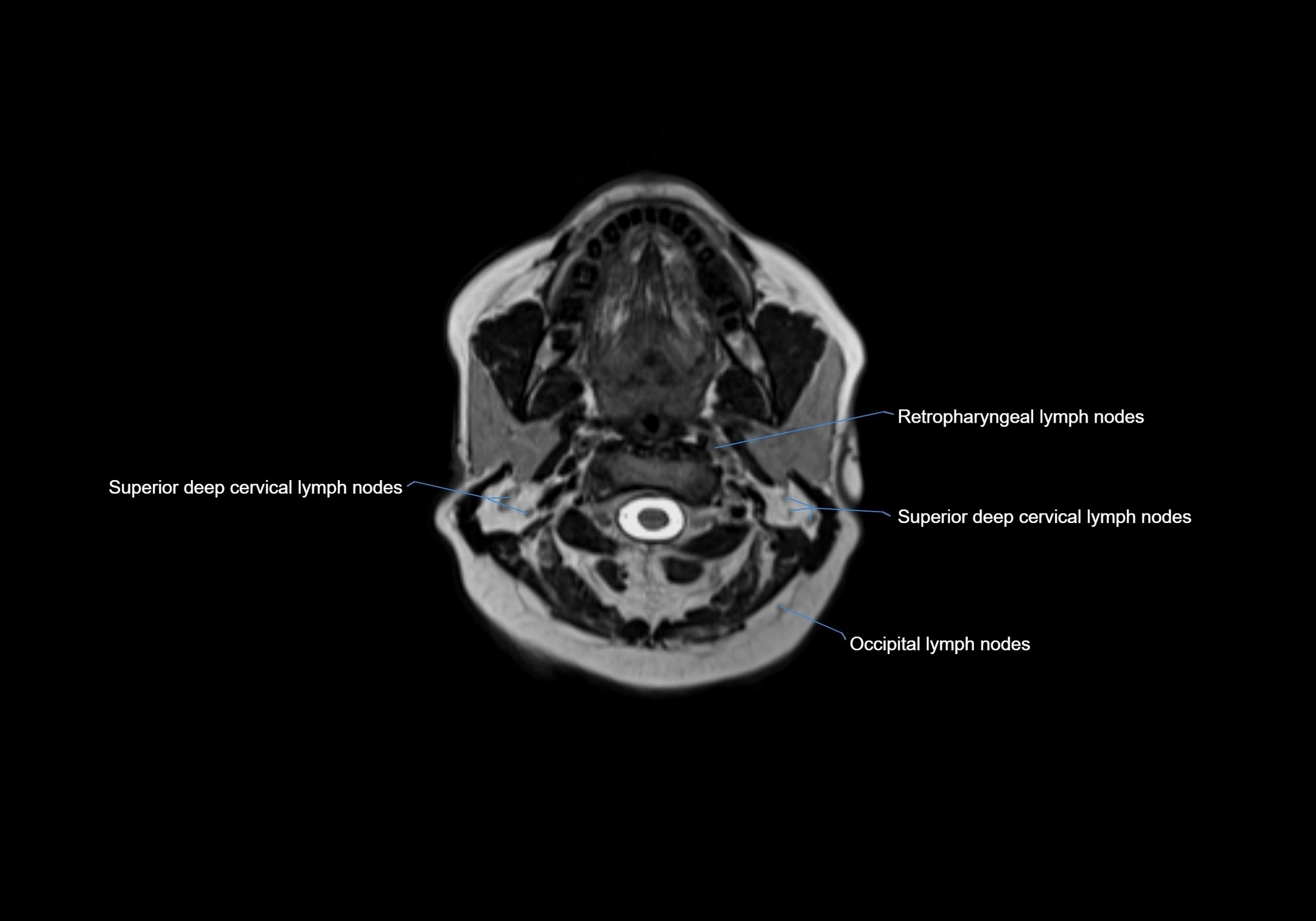 Neck axial  lymph node cross sectional MRI anatomy 3T MRI  image-img-00001-00038.webp